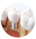 Dental Implantologie implantes